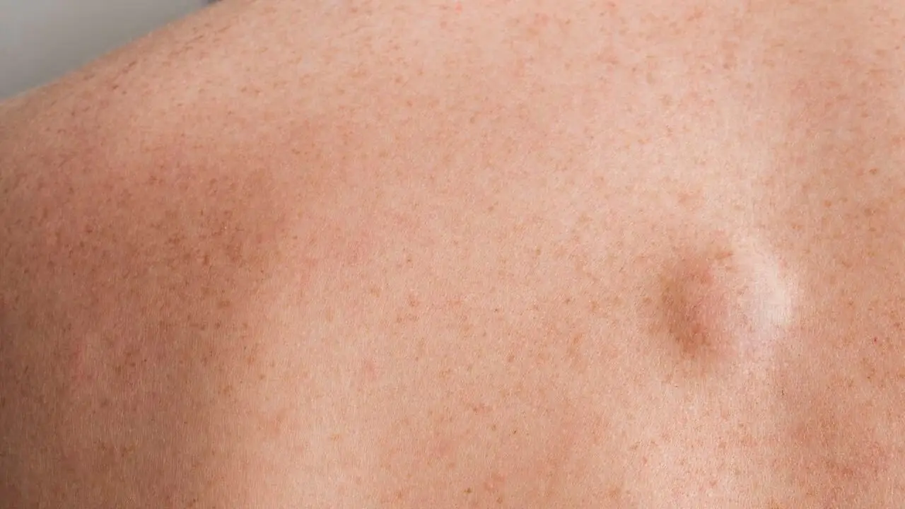 Sarcoma.