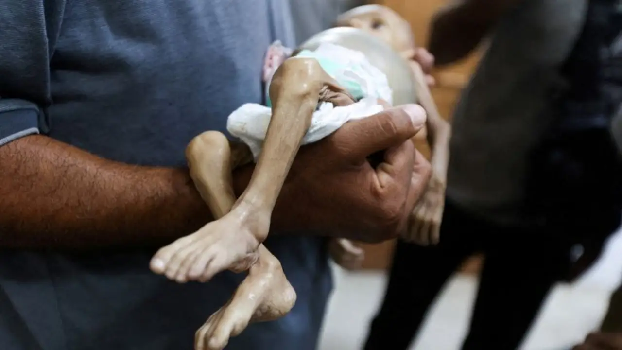 En el pabellón de desnutrición de Gaza, el brazo de un niño es tan grueso como el pulgar de su madre