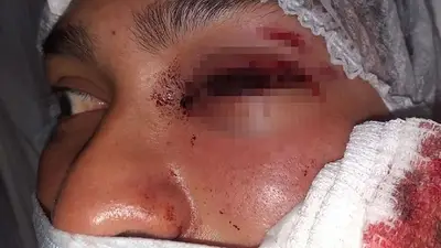 Imputan a cinco policías por hacerle perder un ojo a un soldado voluntario en Salta Imputan a cinco policías por hacerle perder un ojo a un soldado voluntario en Salta