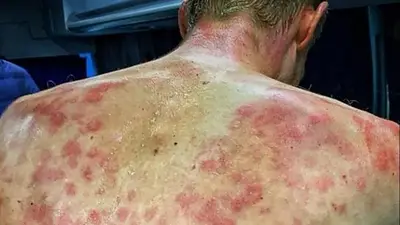 Tormenta de granizo lastimó gravemente la espalda de un ciclista en el Dauphiné 2020 Tormenta de granizo lastimó gravemente la espalda de un ciclista en el Dauphiné 2020