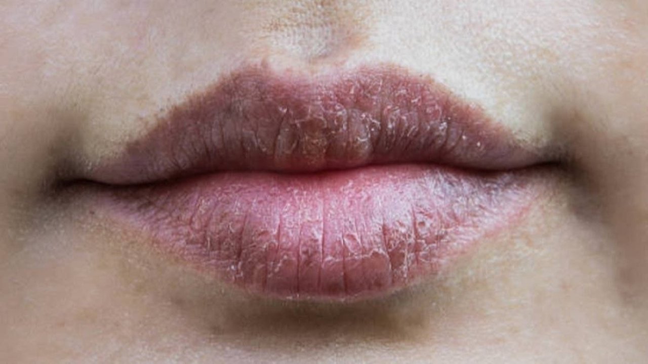 Frío, salud, labios paspados