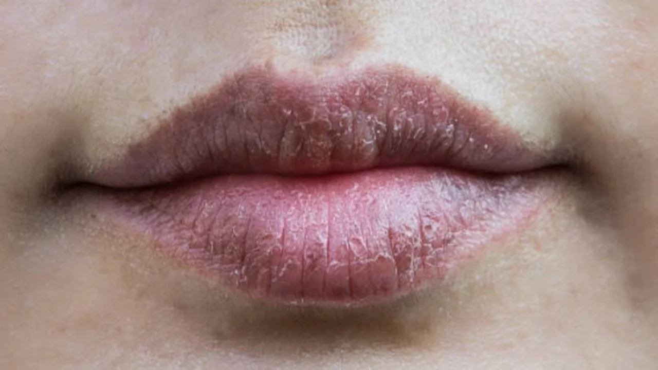 Frío, salud, labios paspados