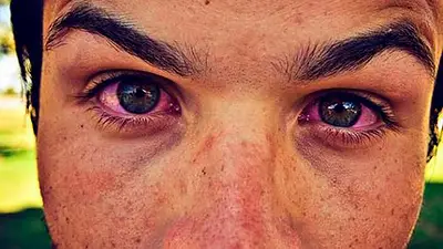 Salud, ojos rojos, enfermedades Salud, ojos rojos, enfermedades