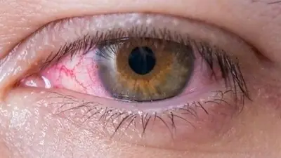 Ojos llorosos Ojos llorosos