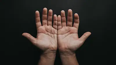 Especialistas de un hospital privado porteño reconstruyeron la mano de un joven al implantarle tres dedos de sus pies. Especialistas de un hospital privado porteño reconstruyeron la mano de un joven al implantarle tres dedos de sus pies.