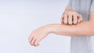 Micosis fungoide. Micosis fungoide.