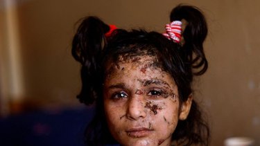 La metralla y la ceguera privan a una joven de Gaza de sus grandes sueños