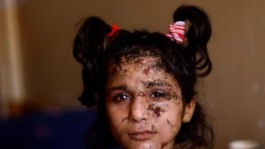 La metralla y la ceguera privan a una joven de Gaza de sus grandes sueños