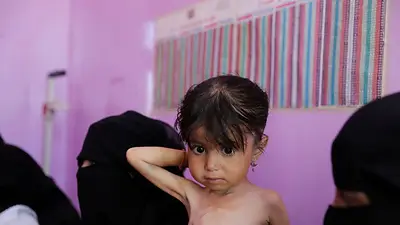 La desnutrición empeora en las zonas controladas por el gobierno yemení, según la ONU La desnutrición empeora en las zonas controladas por el gobierno yemení, según la ONU