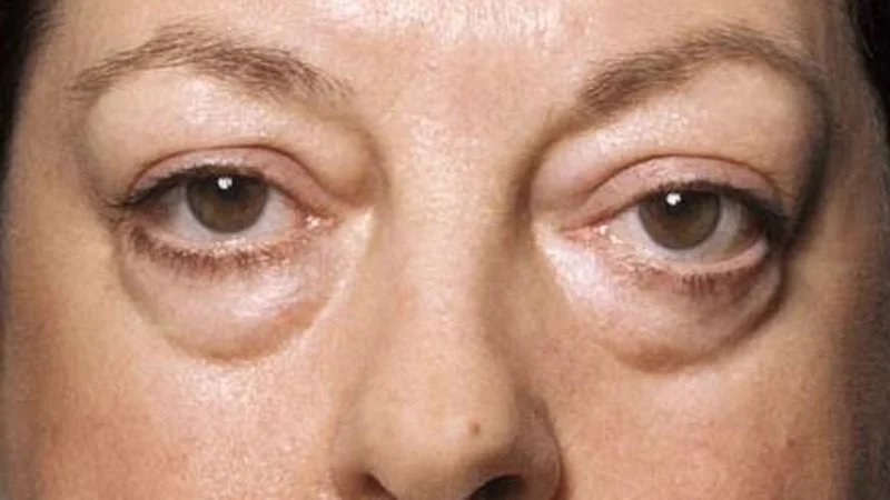 Qué tengo que hacer para reducir la hinchazón en las bolsas de los ojos.