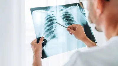 Ante el incremento global de casos de tuberculosis, Formosa intensifica sus acciones de prevención y control Ante el incremento global de casos de tuberculosis, Formosa intensifica sus acciones de prevención y control