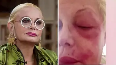 "Puedo perder un ojo": El dramático momento de salud que sufre Carmen Barbieri "Puedo perder un ojo": El dramático momento de salud que sufre Carmen Barbieri