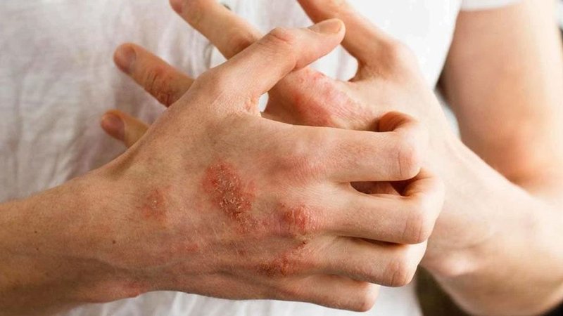 Las manos resecas, una situación habitual que suele sufrir la gente