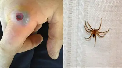 Cómo reconocer una picadura de araña de rincón. Cómo reconocer una picadura de araña de rincón.