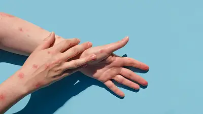 Para la OMS, la viruela del mono sigue siendo emergencia de salud pública Para la OMS, la viruela del mono sigue siendo emergencia de salud pública