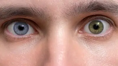 heterocromia heterocromia