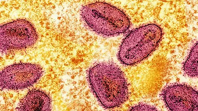 Número de casos de viruela símica en Uganda asciende a 10, dice funcionario Número de casos de viruela símica en Uganda asciende a 10, dice funcionario