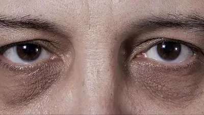 Cómo eliminar las ojeras Cómo eliminar las ojeras