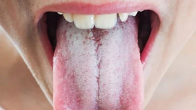 Lengua blanca Lengua blanca