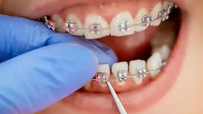 La ANMAT prohibió la venta de brackets falsificados y alertó sobre riesgos para la salud La ANMAT prohibió la venta de brackets falsificados y alertó sobre riesgos para la salud