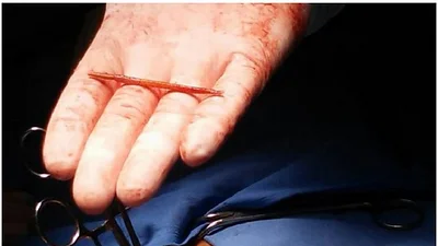Habló el hombre que estuvo 10 meses con un escarbadientes clavado en el corazón y sin saberlo Habló el hombre que estuvo 10 meses con un escarbadientes clavado en el corazón y sin saberlo