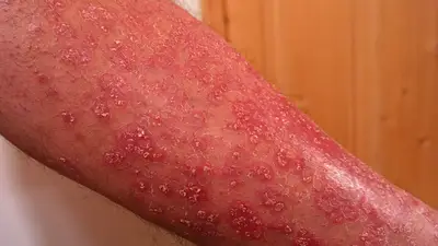 La psoriasis no es contagiosa: síntomas, causas y tratamiento La psoriasis no es contagiosa: síntomas, causas y tratamiento