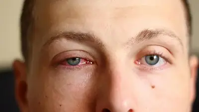 Conjuntivitis Conjuntivitis
