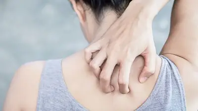 psoriasis psoriasis
