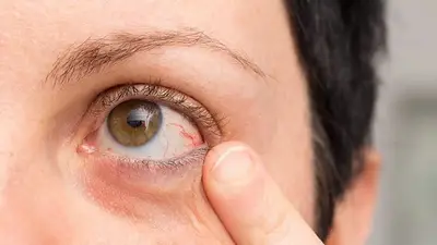 Qué hacer si me pica el ojo Qué hacer si me pica el ojo