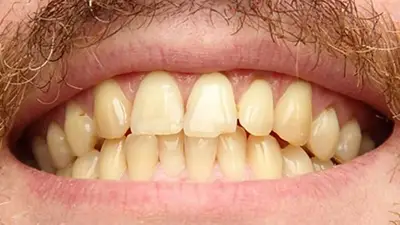 Dientes amarillos. Dientes amarillos.