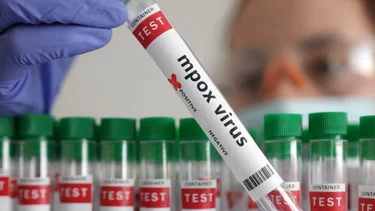 Alemania detecta el primer caso de la nueva variante de la viruela símica