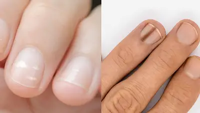 Manchas en las uñas Manchas en las uñas