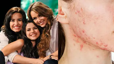 Disney Selena Gomez Miley Cyrus Demi Acne Disney Selena Gomez Miley Cyrus Demi Acne