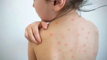 Formosa refuerza la vacunación por el aumento de casos de sarampión en Paraguay: todos los detalles