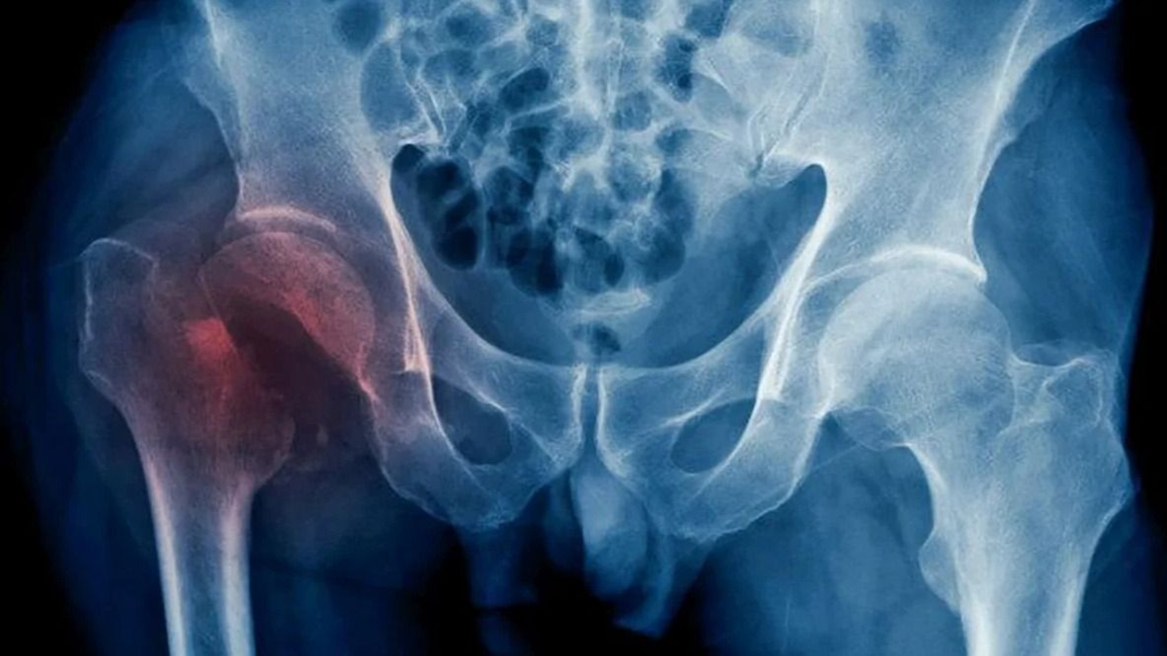 Una de cada tres mujeres mayores de 50 sufren osteoporosis: cómo tratarla a tiempo