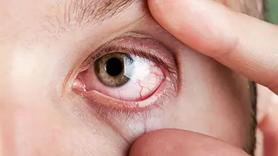 Chau cataratas: este el fruto seco que ayuda a prevenir los problemas de vista Chau cataratas: este el fruto seco que ayuda a prevenir los problemas de vista