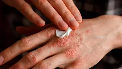 La mano de una persona que padece psoriasis La mano de una persona que padece psoriasis