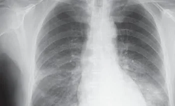 Qué es un adenocarcinoma pulmonar, la enfermedad respiratoria que tiene el papa León XIV  | Salud