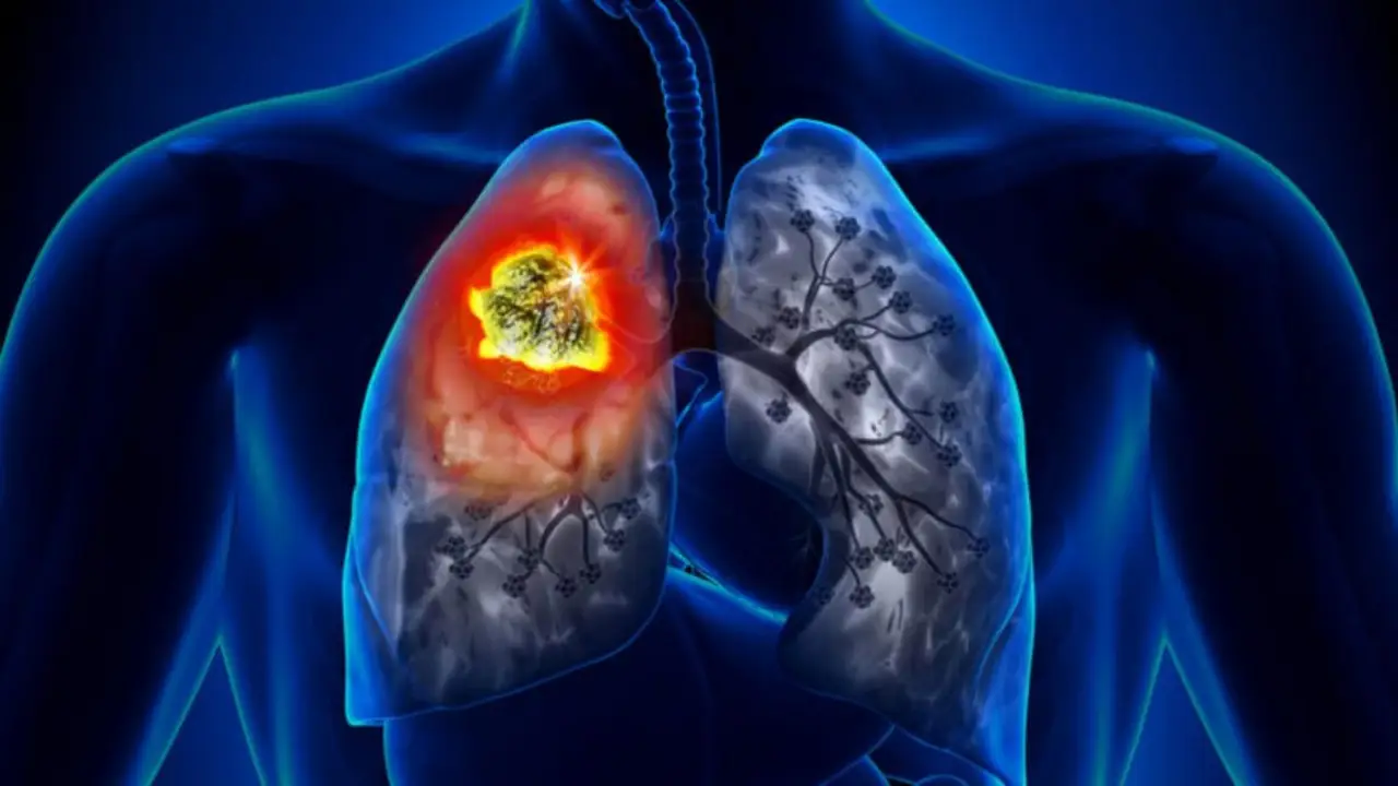 Cáncer de pulmón: alertan por el aumento de casos y el estudio clave que puede prevenir y no se conoce 