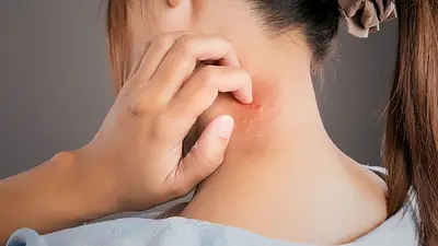 Qué es el lupus, sus síntomas, tipos y tratamiento Qué es el lupus, sus síntomas, tipos y tratamiento