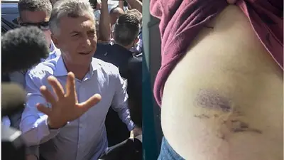 Así quedó el periodista que fue golpeado por custodios de Macri Así quedó el periodista que fue golpeado por custodios de Macri