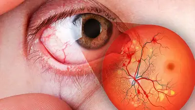 Ceguera por diabetes: estiman que en 2030 unas 552 millones personas la padecerán en el mundo Ceguera por diabetes: estiman que en 2030 unas 552 millones personas la padecerán en el mundo