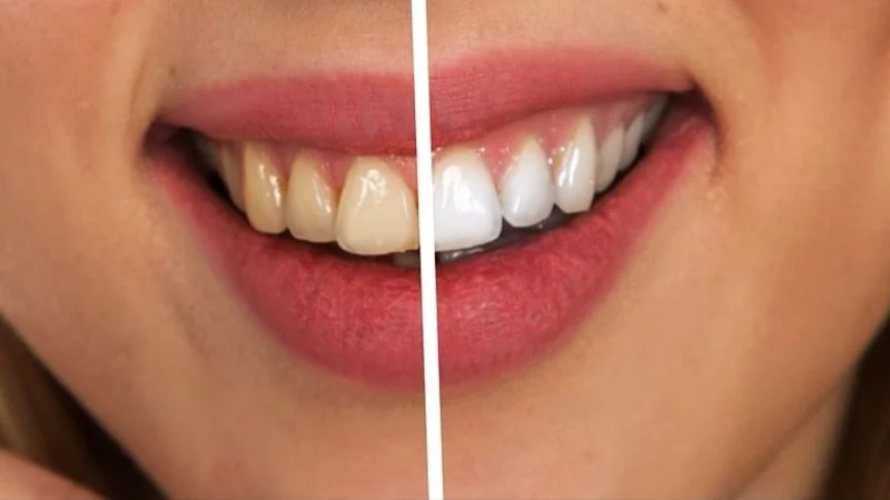 Dientes blancos