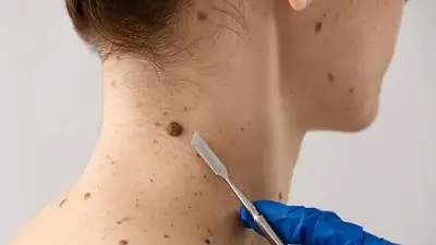 El Gobierno de Formosa se suma la Campaña Nacional de Prevención del Cáncer de Piel: todos los detalles El Gobierno de Formosa se suma la Campaña Nacional de Prevención del Cáncer de Piel: todos los detalles
