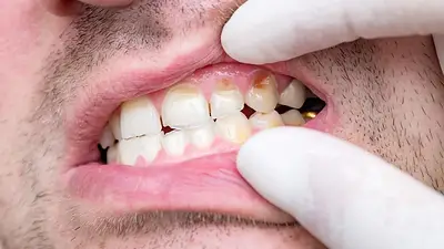 Dientes con sarro. Dientes con sarro.