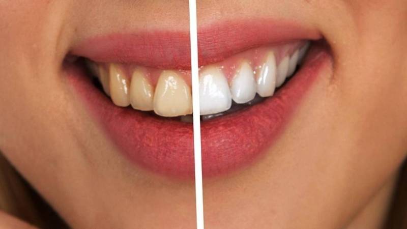 Dientes blancos