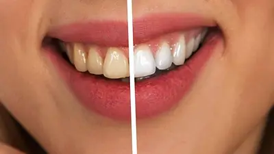Dientes blancos Dientes blancos