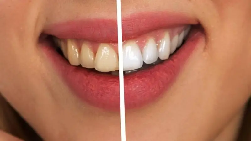 Dientes blancos
