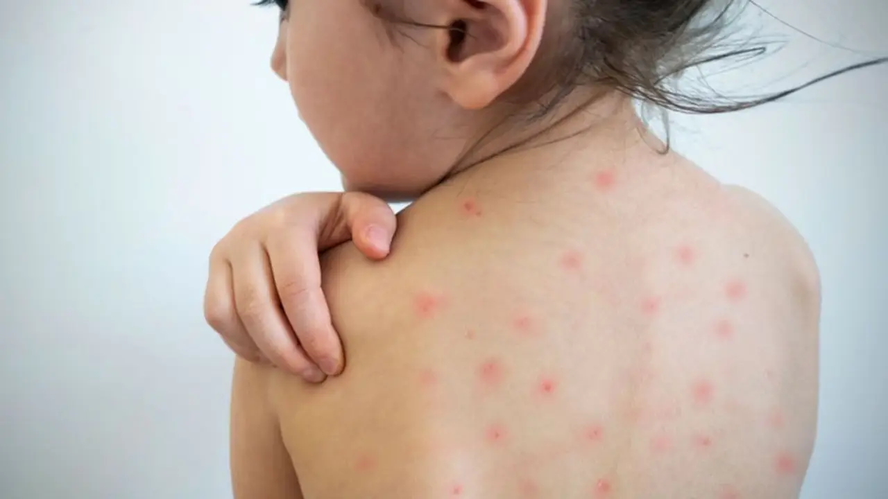 Riesgo antivacunas: decretaron cuarentena en Estados Unidos por un brote de sarampión