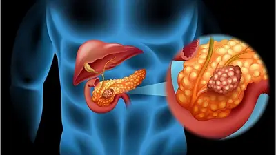 A partir de los 60 años: las 8 señales de tu cuerpo para detectar un cáncer de páncreas a tiempo A partir de los 60 años: las 8 señales de tu cuerpo para detectar un cáncer de páncreas a tiempo
